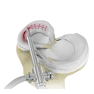 Meniscal Balancing / Repair